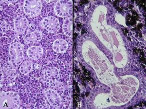 Histologische Aufnahme des Nierengewebes einer Bachforelle. (A) Unverändertes Nierengewebe (B) Schadstoffbedingte Nierenveränderungen